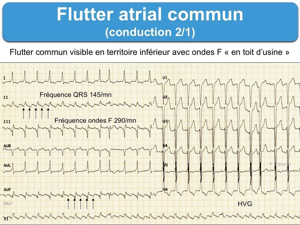 Atrial Flutter 1.1. Тахисистолия. Atrial Flutter ECG 2:1,4:1. Flutter auriculaire. Flutter dio