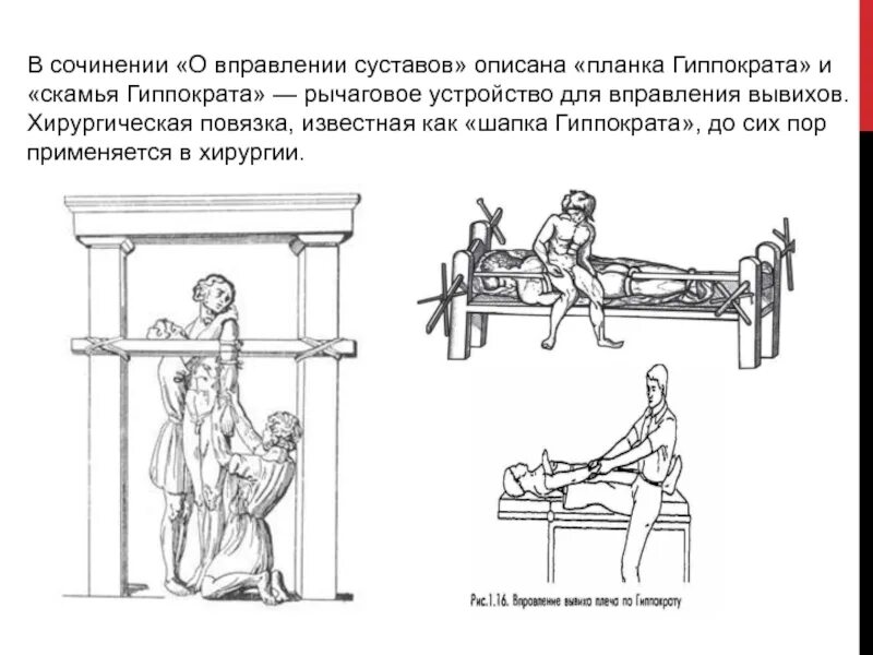 Какой принцип оздоровительной тренировки соответствует завету гиппократа. Вправление плеча по гиппократу. задача гиппократа. лечебница гиппократа одиссея.