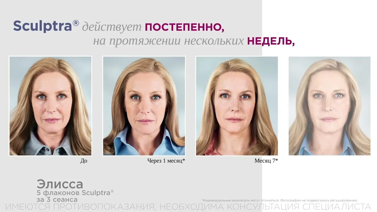 Sculptra (италия) 1 флакон. Филлер скульптра полимолочная кислота. Скульптра sculptra отзывы. Скульптра sculptra осложнения. Косметологический препарат скульптра.