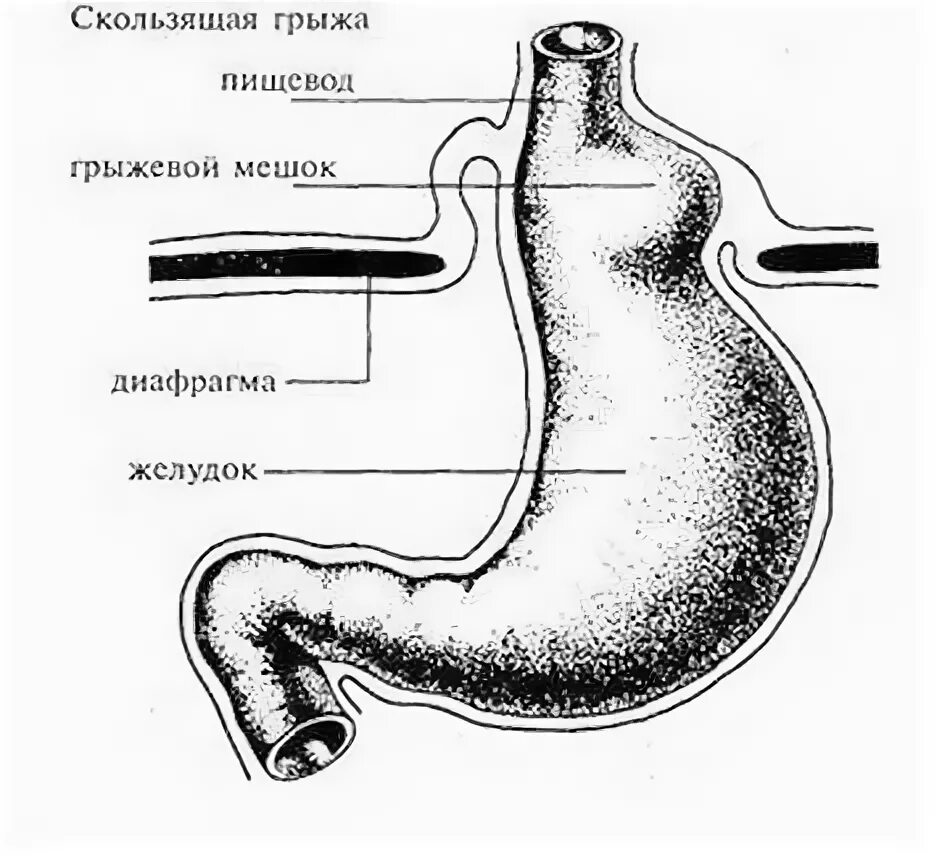 Пищевод без желудка. Скользящая хиатальная грыжа. Диафрагмальная грыжа желудка. Грыжа пищеводного желудка. Скользящая грыжа желудка.