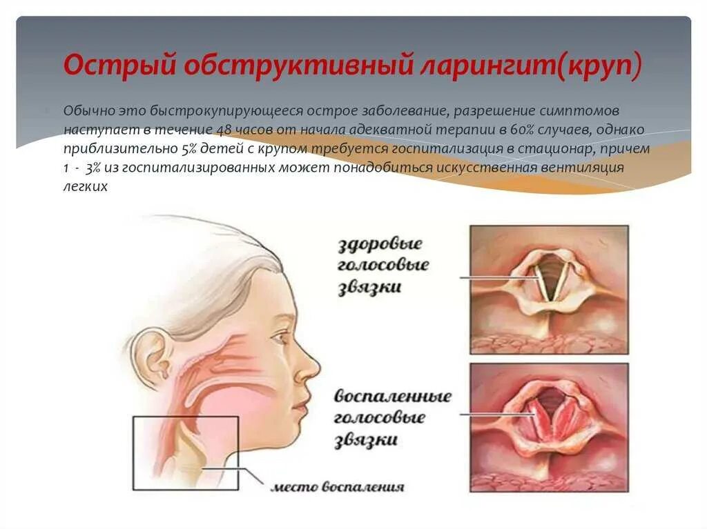 Помощь при стенозирующем ларингите. Помощь при стенозирующем ларингите