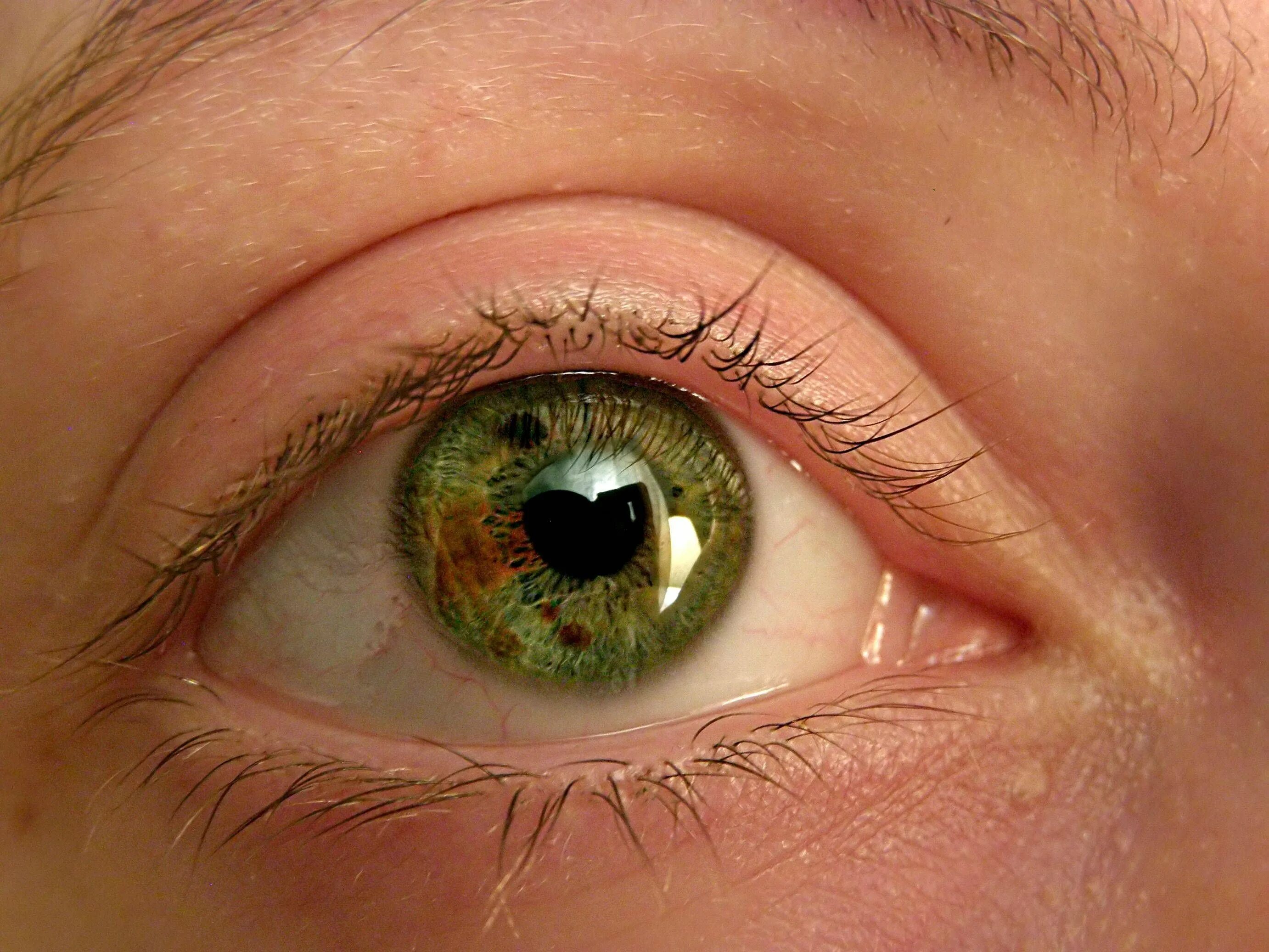 Pupula duplex двойной зрачок. Поликория радужной оболочки. В каждом глазу по два зрачка. В каждом глазу по два зрачка. В каждом глазу по два зрачка.