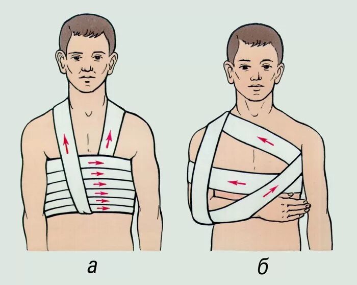 Первая медицинская помощь при переломе ребер. Перелом ребер иммобилизация повязка. Перелом ребер повязка Дезо. Бинтовая повязка Дезо. Перевязки бинтом Дезо.