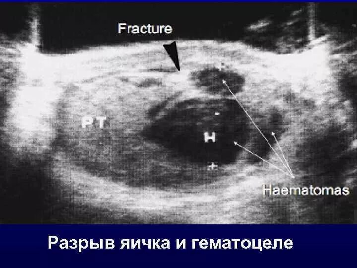 Разрыв половых органов. Разрыв половых органов
