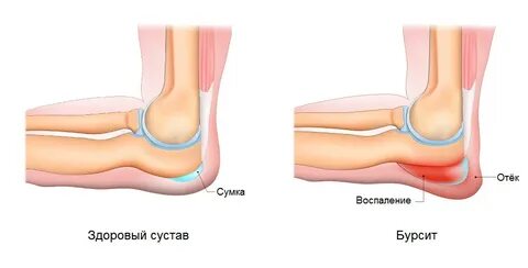 Локтевой бурсит мкб 10 у взрослых