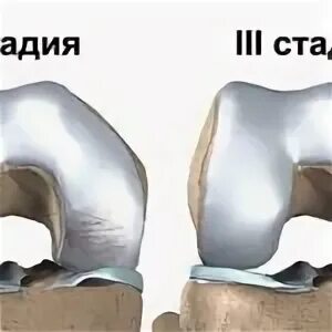 Хондромаляция медиальных мыщелков бедренной кости. Болезнь Кёнига рассекающий остеохондрит. Рассекающий остеохондрит мрт. Болезнь Кёнига рассекающий остеохондрит мрт. Рассекающий остеохондрит межмыщелкового возвышения.