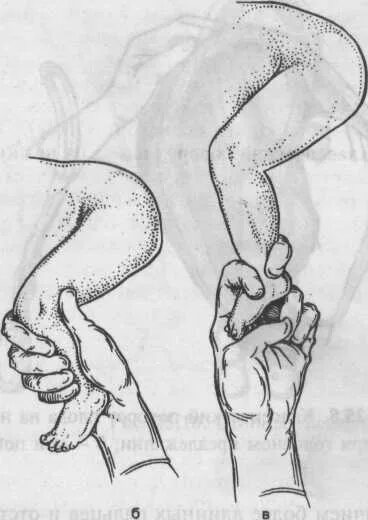 Спазмофилия симптом люста. Пальцы акушера. Оказание акушерского пособия в родах. Судороги при спазмофилии. Формирование руки акушера.