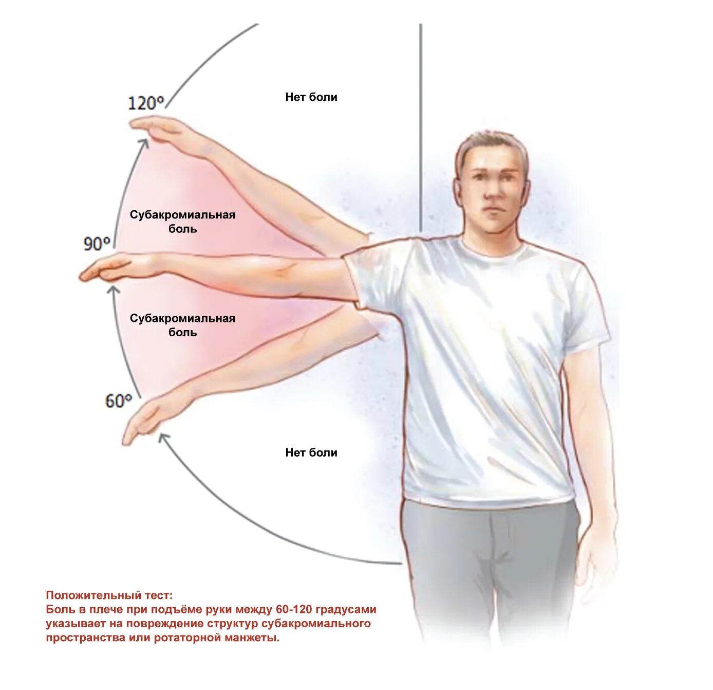Болезненно тест. Субакромиальный синдром плечевого сустава ЛФК. ЛФК при импиджмент синдром правого плечевого сустава. Лечебная физкультура при импинджмент синдроме плечевого сустава. Боль руки в плечевом плечевом суставе.