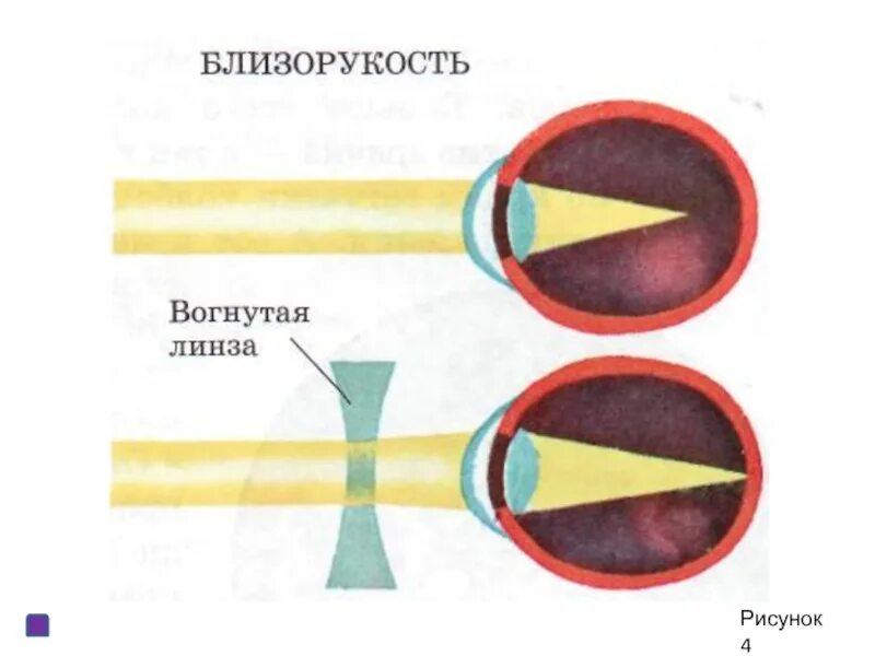 Анализаторы биология 8 класс видеоурок. Зрительный анализатор близорукость. Анализатор зрения биология. Зрительный анализатор дальнозоркость и близорукость. Близорукость схема глаза.