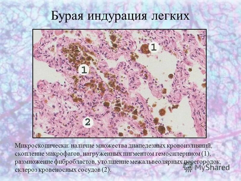 Печень микропрепарат описание. Бурая индурация легких патанатомия. Хроническое венозное полнокровие легких бурая индурация. Венозное полнокровие печени гистология. Бурое уплотнение легкого микропрепарат.