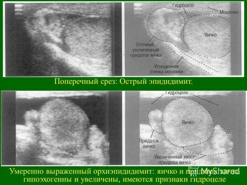 Придаток яичка на УЗИ норма. Утолщение оболочек яичка на УЗИ. Жидкость в оболочках яичка на УЗИ.