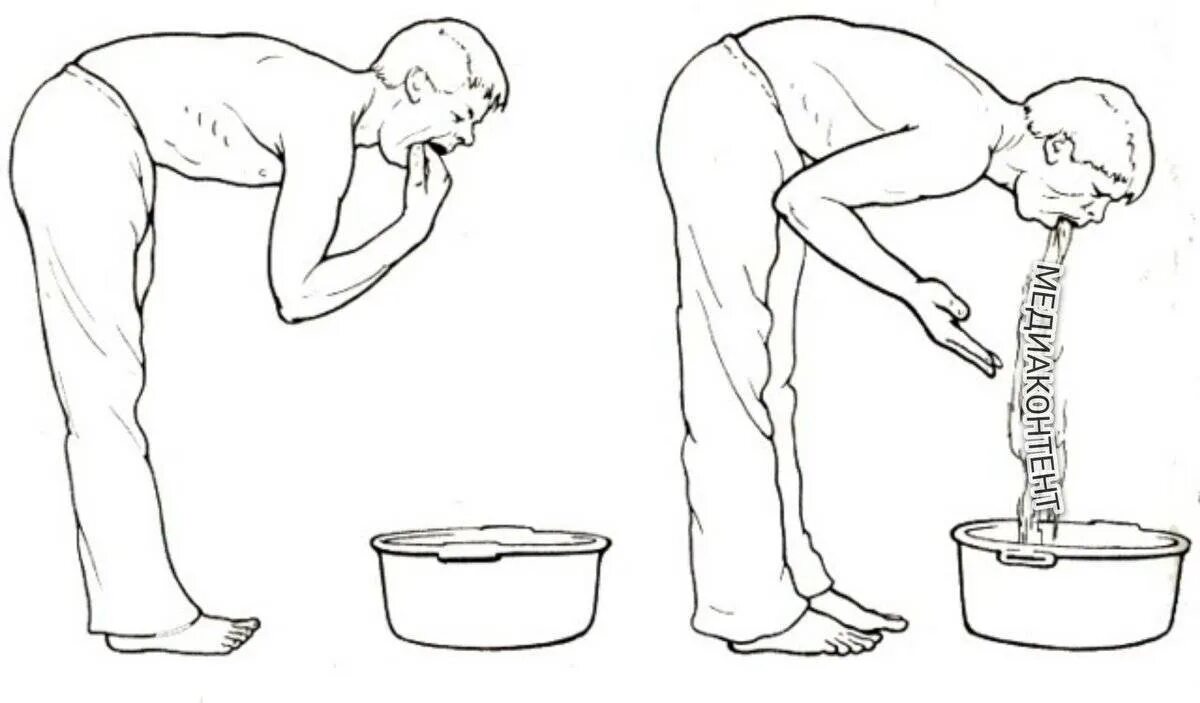 Пью воду и тошнит. Промывание желудка. Рвота промывание желудка. Беззондовое промывание желудка. Промывание желудка при отравлении.