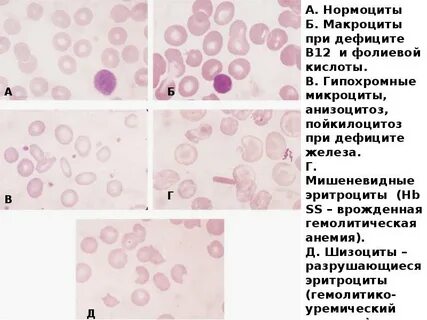 Анизоцитоз повышен у женщины