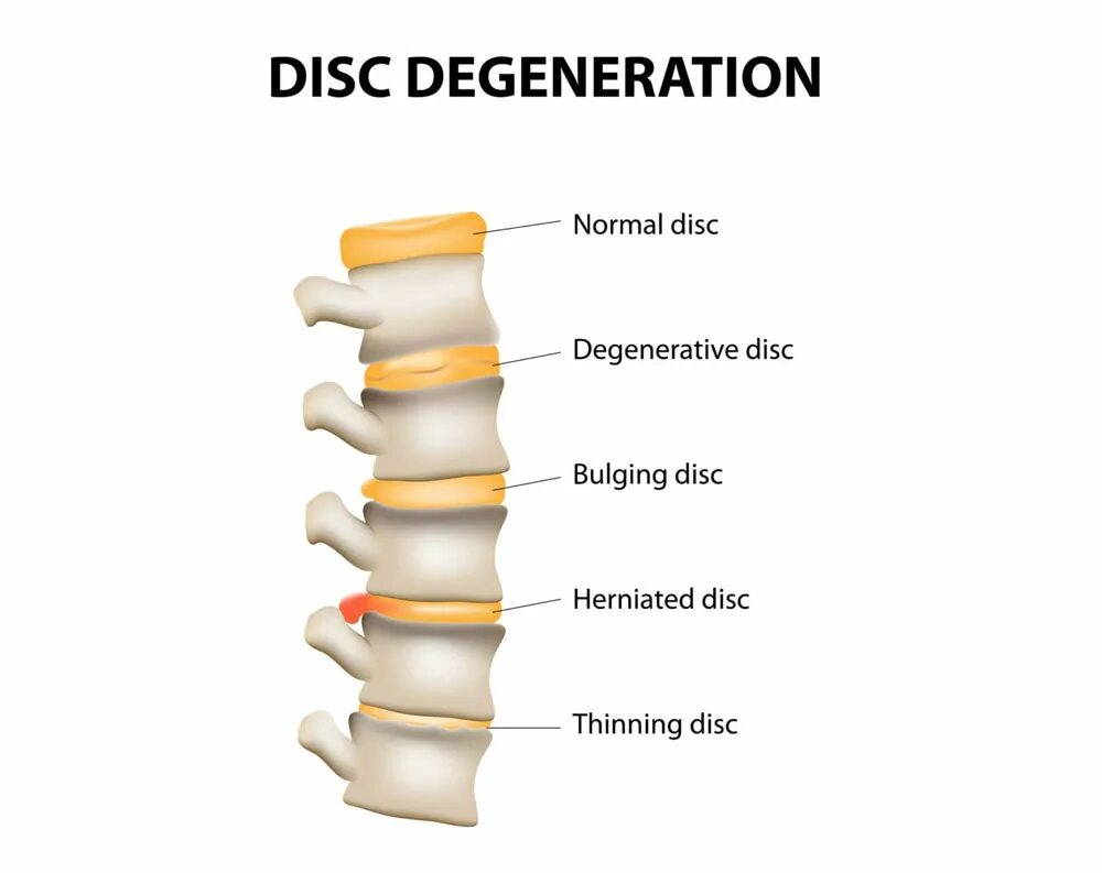 Спинные диски. Протрузия межпозвонковых дисков. Грыжи и протрузии позвоночника. Протрузия и грыжа. Протрузия дисков позвоночника что это такое.