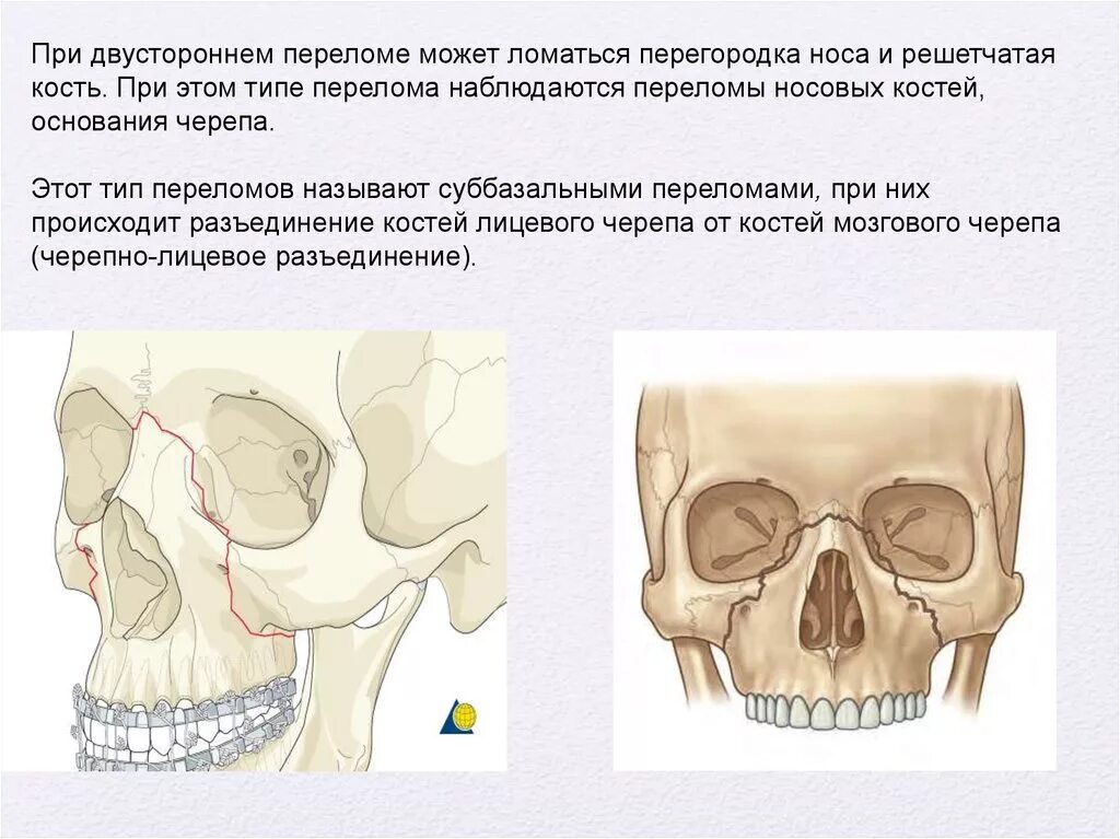 Перелом решетчатой кости носа. Переломы верхней и нижней челюсти. Перелом ячеек решетчатой кости. Перелом решетчатой пазухи.