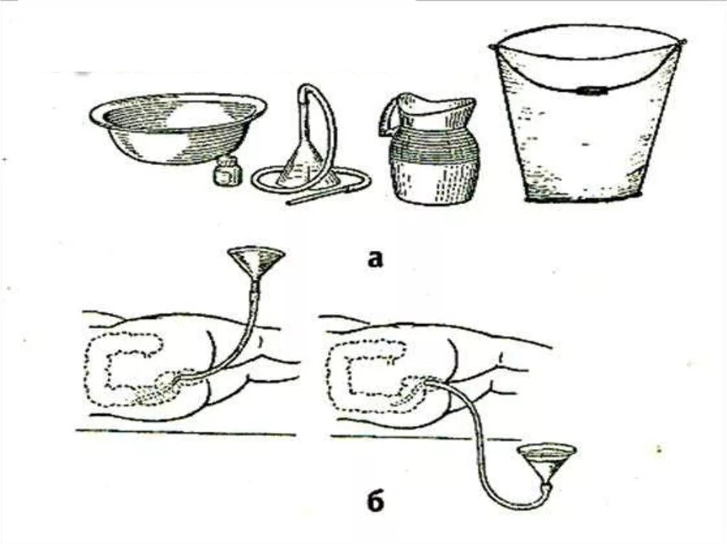 Манипуляция очистительная клизма. Сифонная клизма 20 литров. Постановка сифонной клизмы алгоритм. Очистительная клизма оснащение. Необходимое оснащение для очистительной клизмы.
