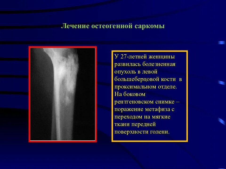 Очаговые изменения костей. Остеосаркома кости рентген. Саркомы костей рентген. Симптомы саркомы бедренной кости у детей. Опухоли бедренной кости на рентгенограммах.