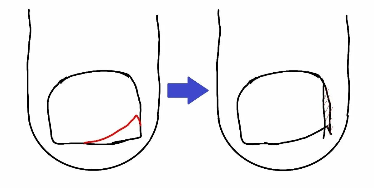 Как подстричь ноготь на пальце. Вросший ноготь на большом пальце ноги. Вросший ноготь схема врастания. Подстричь вросший ноготь.