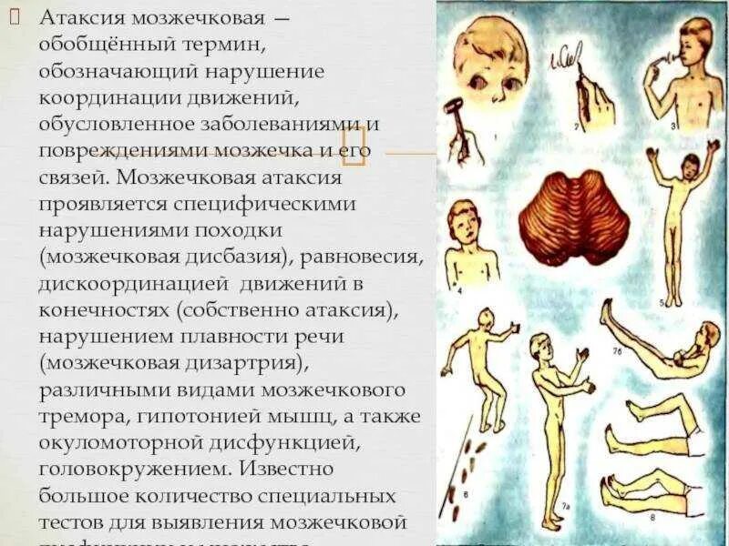 Нарушение координации движений признак. Мозжечковая атаксия. нарушение координации движения. мозжечкавая емиетаксия. походка при поражении мозжечка.