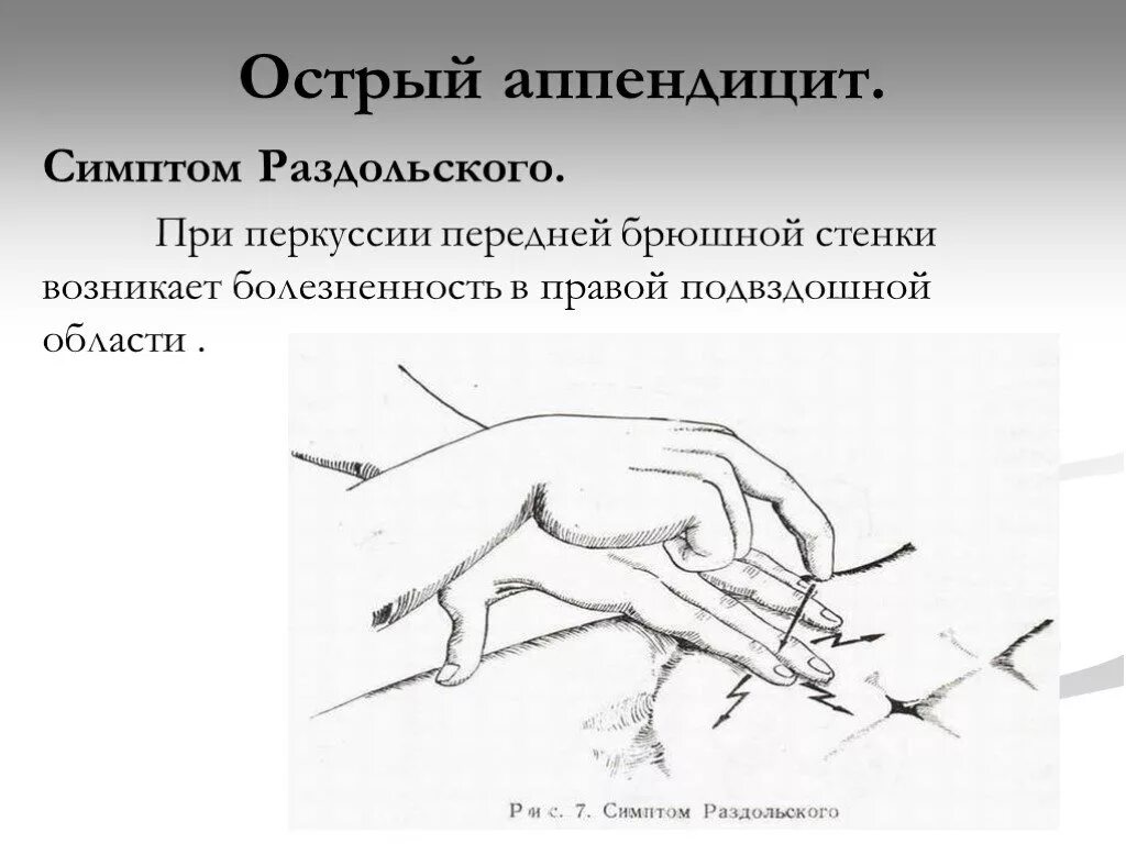 Аппендицит щеткин блюмберг. Острый аппендицит симптом Раздольского. Симптомы острого аппендицита пальпация. Острый аппендицит перкуссия. Хирургические симптомы острого аппендицита.