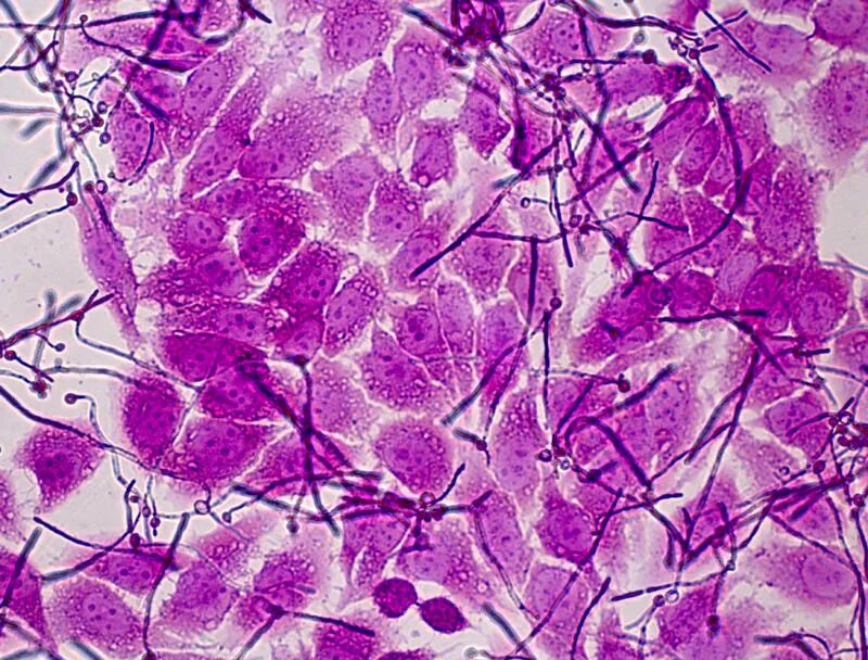 кандида легких