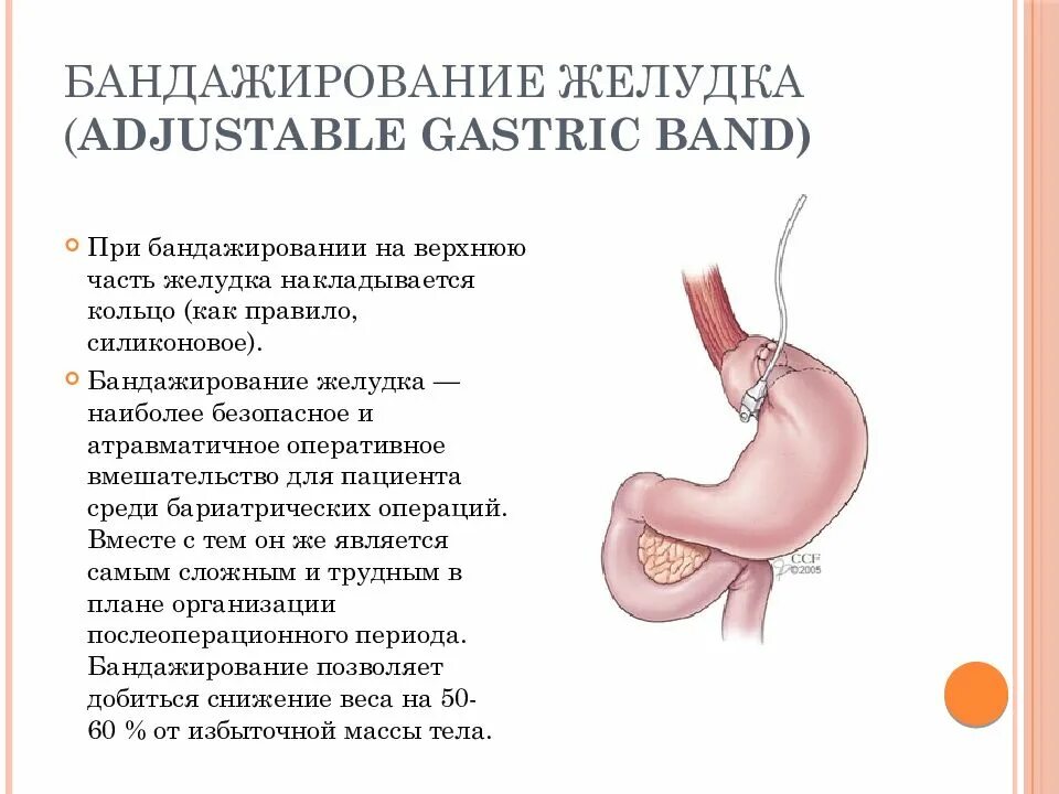 Бариатрическая операция. Бандажирование желудка. Бариатрические операции на желудке. Бариатрическая хирургия презентация.