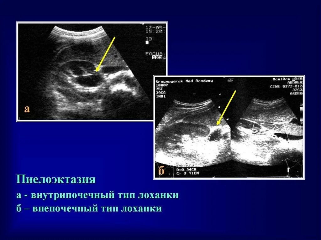 Узи лоханки почки. Расширение лоханки почки на УЗИ. Пиелокаликоэктазия почки на УЗИ. Расширенная почечная лоханка на УЗИ. Расширенная лоханка почки на УЗИ.