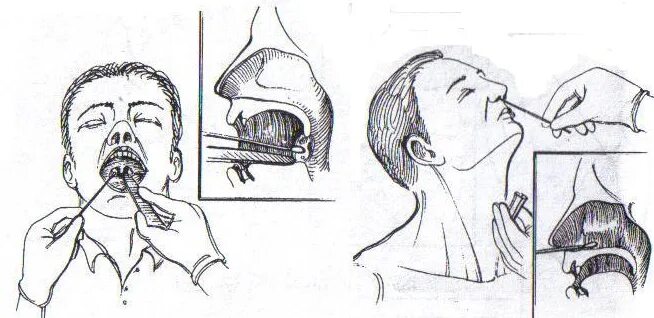 Посев полости рта. Забор мазка из зева и носа. Взятие мазков из зева и носа. Забор мазка из зева для бактериологического исследования алгоритм. Взятие мазка из зева для бактериологического исследования.