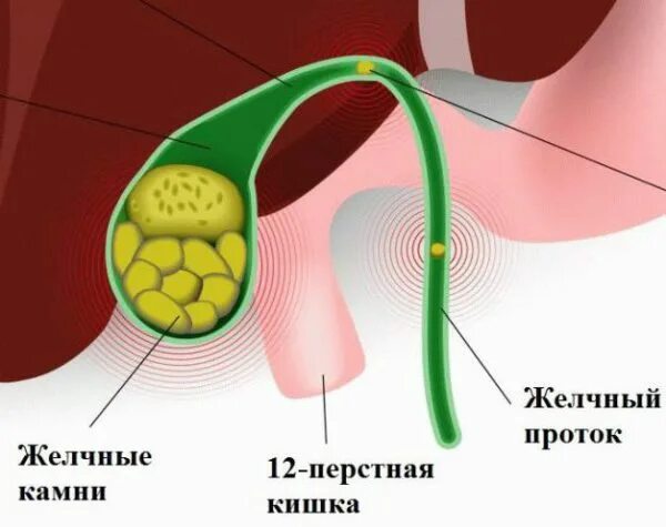 Вода для желчного пузыря. Удаленный желчный пузырь. Болезни желчного пузыря.