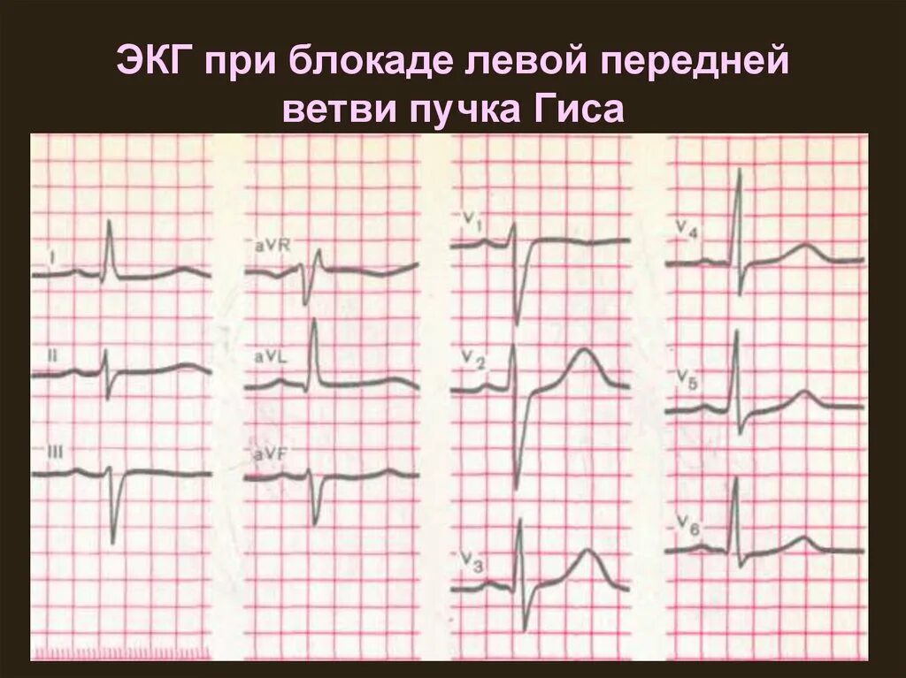 Блокада левой ножки пучка гиса на экг. Блокада передневерхнего разветвления левой ножки пучка Гиса. Блокада передней ветви левой н.п Гиса что такое. ЭКГ при блокаде левой ножки пучка Гиса и инфаркта. Блокада левой ножки пучка Гиса и инфаркт миокарда на ЭКГ.