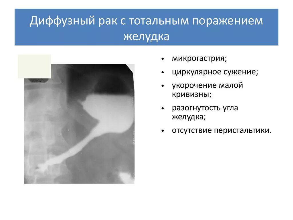 Диффузно инфильтративная. Тотальное поражение желудка онкология. Новообразование желудка рентген. Диффузно-инфильтративная опухоль желудка. Циркулярное сужение желудка.