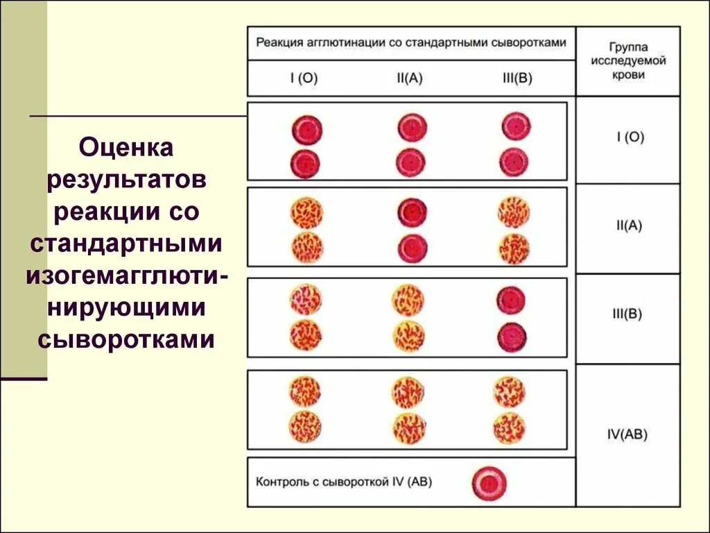 Реакция агглютинации со стандартными сыворотками. Схема реакции агглютинации группы крови. Реакция агглютинации со стандартными сыворотками группа крови. Реакция агглютинации со стандартными сыворотками таблица. Принцип групп крови