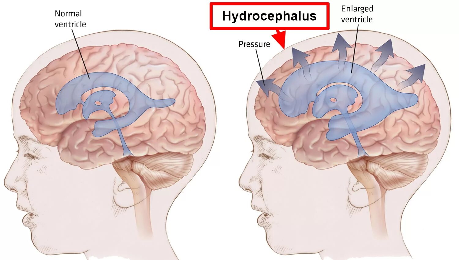 Отек мозга у пожилых причины. Желудочки головного мозга при гидроцефалии. Гиперсекреторная гидроцефалия. Гипертензионно-гидроцефальный синдром у новорожденных симптомы. Церебральная ишемия у новорожденного 2 степени.