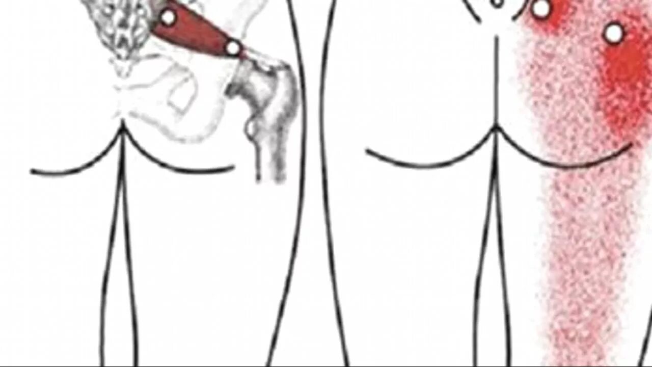 Боль в правой ноге от паха. Боли в спине выше поясницы. Триггерные точки на ягодицах. Растяжение в паху у мужчин. Боль в правой ноге от паха.