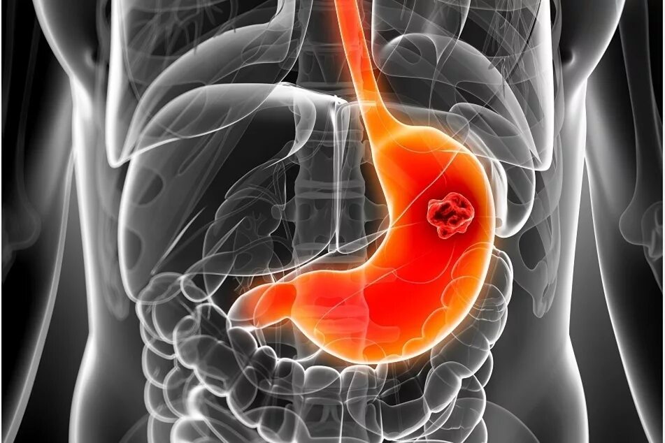 онкология кишечно желудочного тракта. злокачественная опухоль пищеварительного тракта. злокачественные новообразования жкт. рентген пищеварительного тракта. рентгенография пищевода желудка и дпк.
