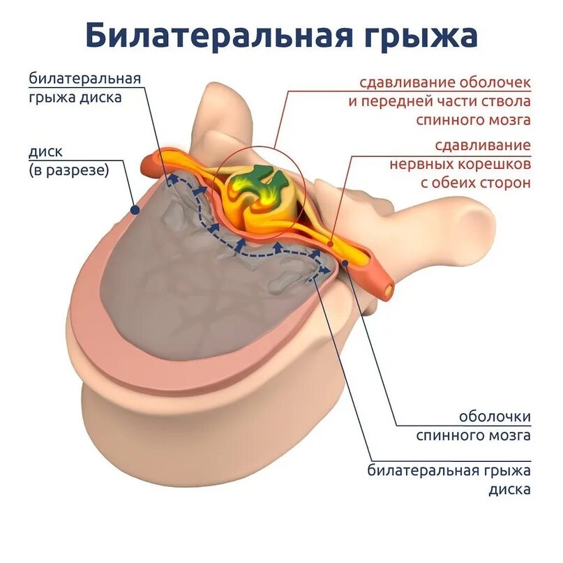 Медианно парамедианная протрузия диска. Медианно-парамедианная билатеральная грыжа. билатеральная грыжа позвоночника. парамедианная билатеральная протрузия.