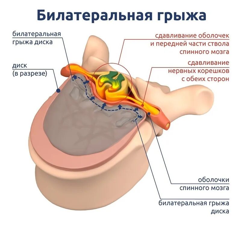 Медианно парамедианная билатеральная. Билатеральная грыжа позвоночника. Медианно-парамедианная билатеральная грыжа. Билатеральные грыжи дисков.