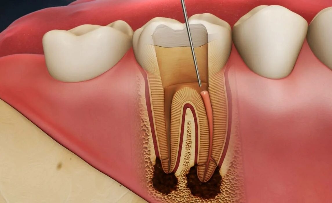 Root canal. Конкрементозный пульпит. Гипертрофический пульпит.