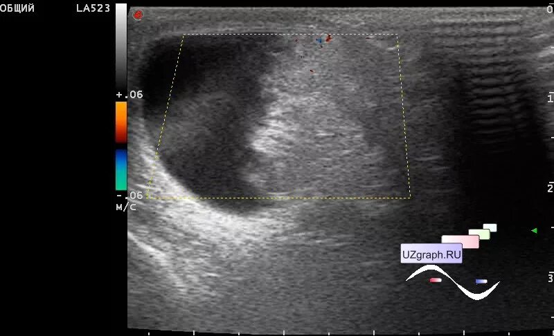 Пахово-мошоночная грыжа на УЗИ. Паховая грыжа в мошонке на УЗИ. Можно увидеть грыжу на узи