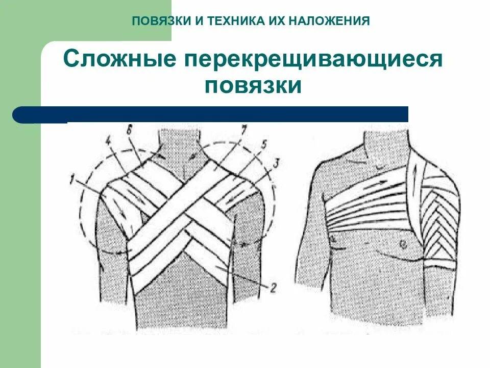 Перевязка Дезо. Повязка Дезо бинтом. Восьмиобразная повязка при переломах ключицы. Повязка Дезо манипуляция.