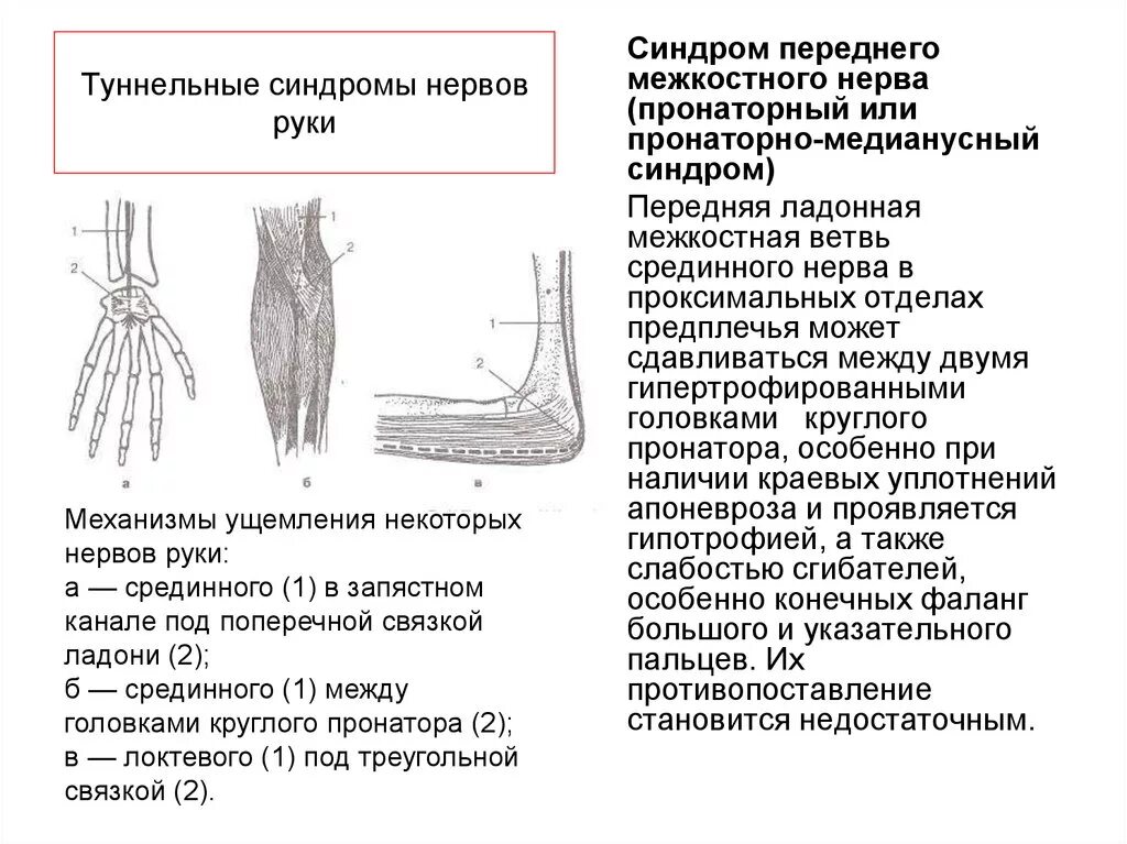 Локтевая невропатия лечение. Туннельный синдром срединного нерва. Карпальный туннельный синдром локтевого нерва. Туннельный синдром лучевого нерва. Синдром переднего межкостного нерва.