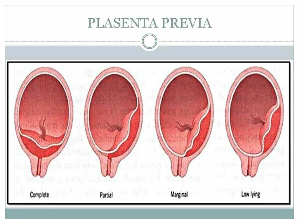 Плацента перекрывает внутренний зев. Краевое предлежание плаценты перекрытие зев. Предлежание плаценты внутренний зев закрыт. Хорион перекрывает внутренний зев. Зев закрыт при беременности