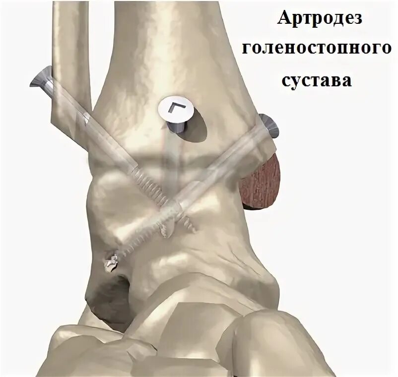 После артродеза голеностопного сустава. Операция артродез голеностопного сустава. Операция артродез голеностопного сустава восстановление. Артродезирование (артродез) сустава.