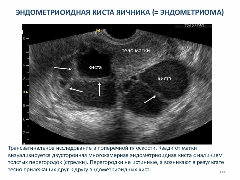 Эндометриоидная киста яичника на УЗИ. Мультилокулярная киста яичника. Эндометриоидная киста яичника диагноз. Эндометриоидная киста яичников симптомы. Эндометрия скудная