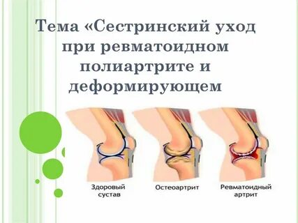 Ревматоидный артрит остеоартроз