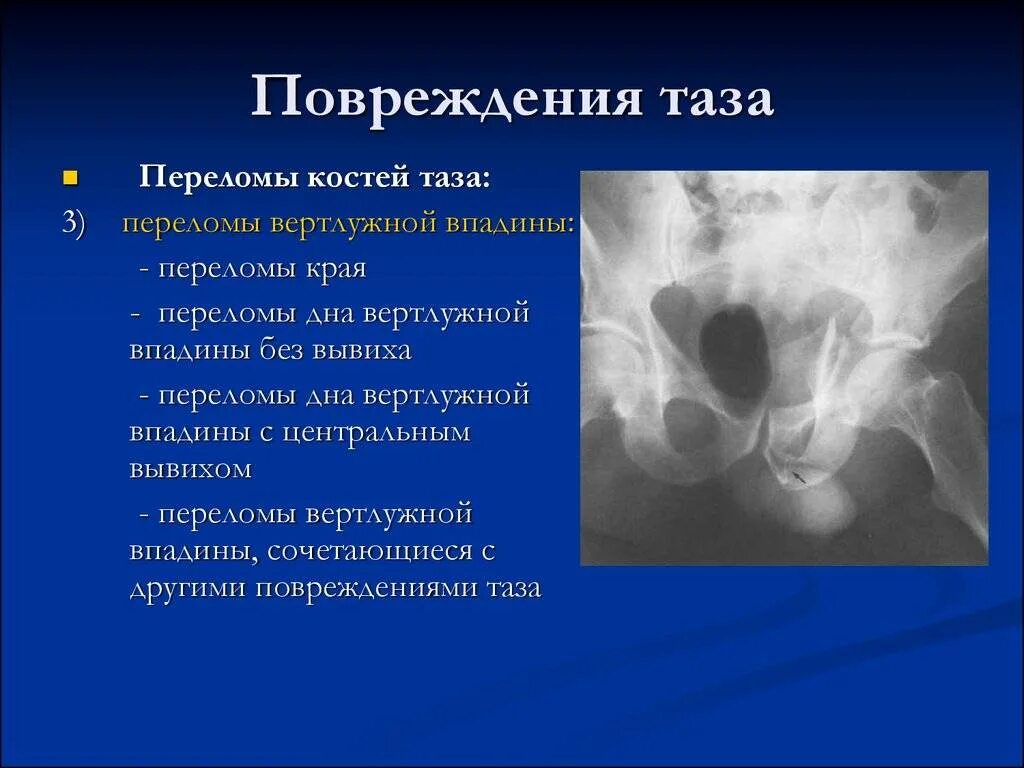 Разрыв кости. Таз травма вертлужной впадины. Клинические симптомы травмы костей таза. Осложнения повреждения таза.