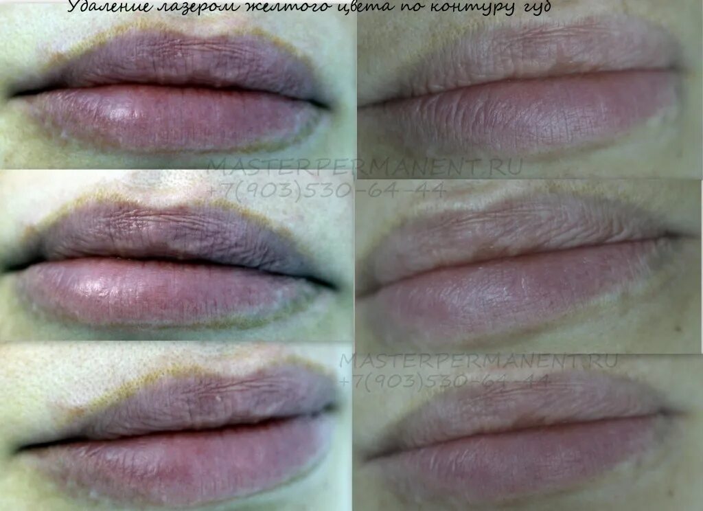 Перманент губ контур. Татуаж губ после лазера. Перманент губ. Перманент губ. Губы после перманентного макияжа.
