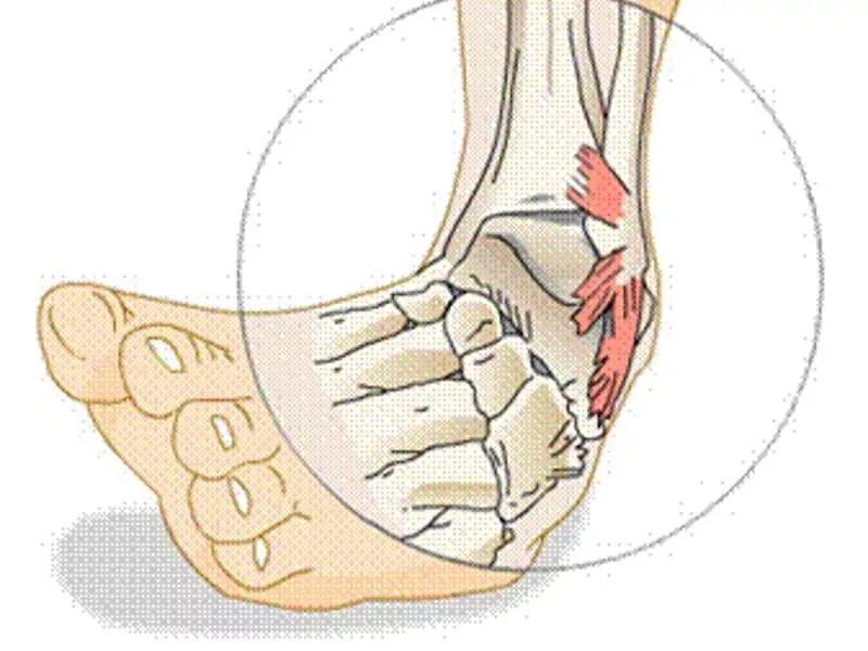 Подвернул голеностопного сустава. Растяжение связок голеностопа. Повреждение связок голеностопного сустава мкб 10. Повреждение капсульно-связочного аппарата стопы. Растяжение связок голеностопного сустава рисунок.