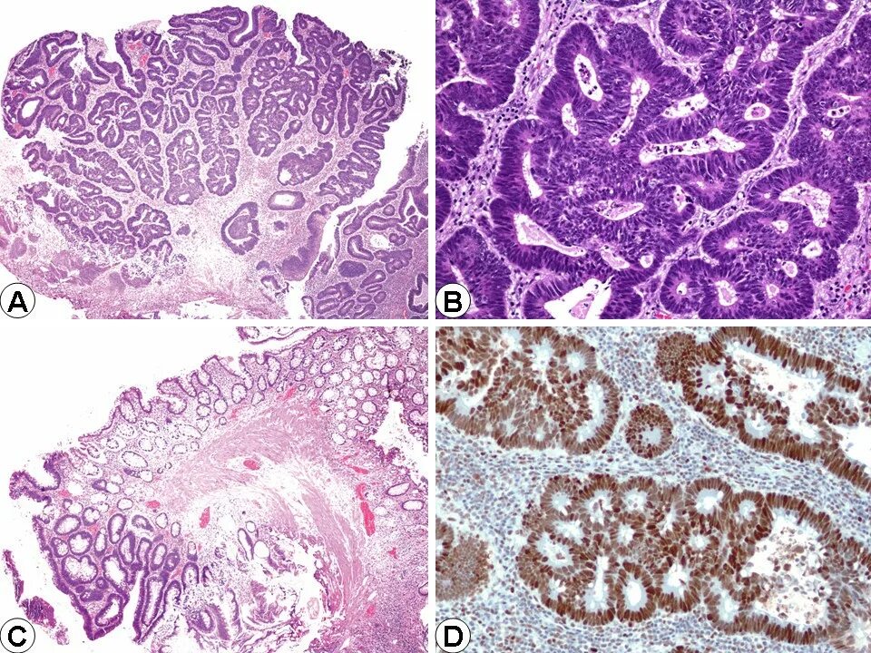 Тубулярная аденома толстой. Тубуло ворсинчатая аденома гистология. Аденома сальных желез патанатомия. Ворсинчатая аденома желудка гистология. Ворсинчатая аденома High Grade.
