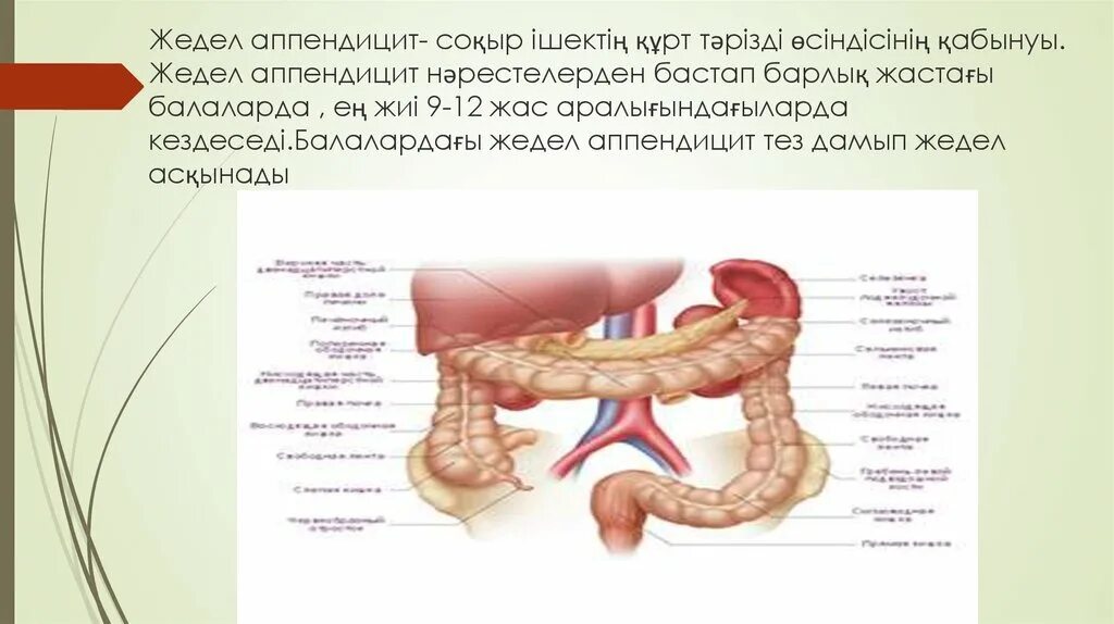 Аппендицит шпаргалка. Аппендицит презентация.